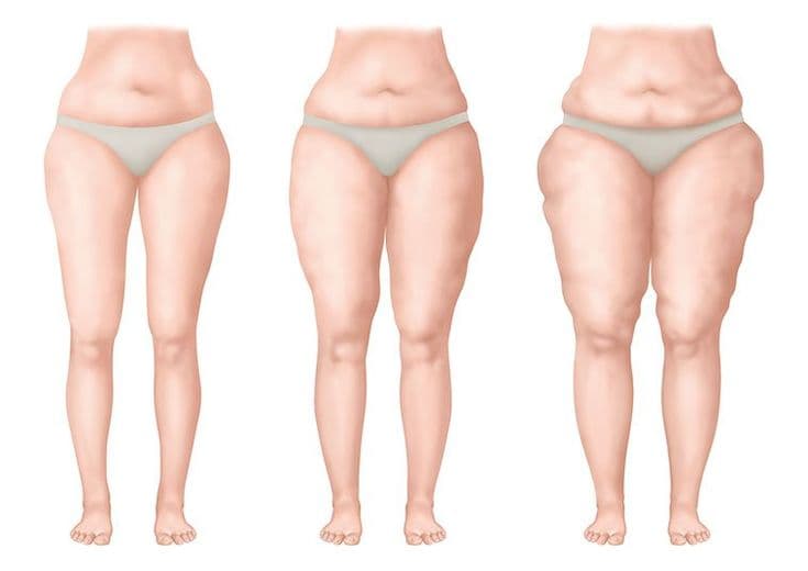 Lipödemle Yaşamak: Diyetisyenden Egzersiz, Psikoloji ve Günlük Hayat Rehberi